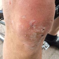 Radtour Von Scherwiller Ins Val D Argent Blessuren